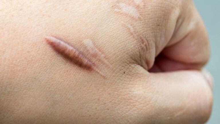 Scars