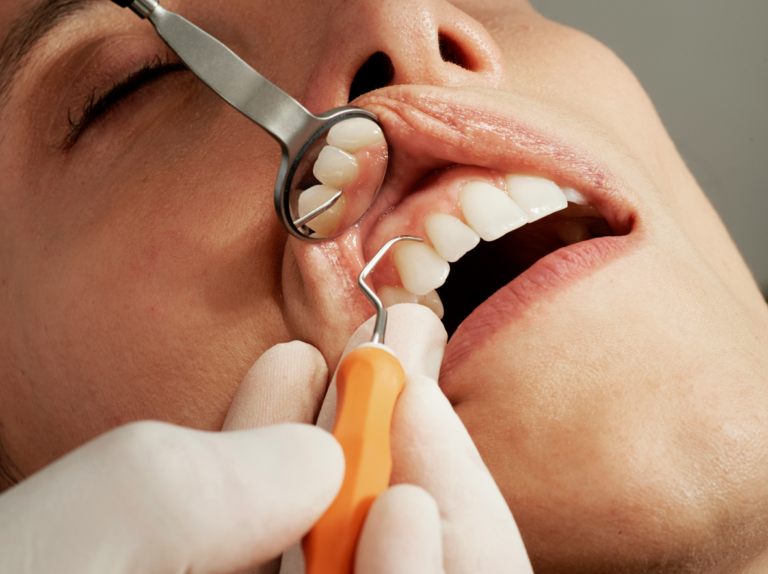 Preventing Sports-Related Dental Injuries: The Importance of Mouthguards and Protective Gear